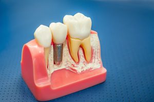 Implantes Dentales
