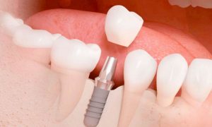 ¿De qué está hecha la corona de un implante dental?
