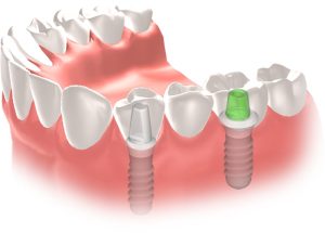 ¿Se pueden instalar 2 o más implantes al mismo tiempo?