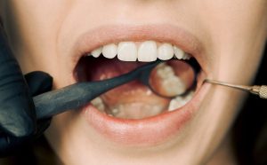 Implantes Subperiósteos: Una buena solución