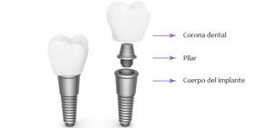 ¿Cuál es el pilar en un implante dental?