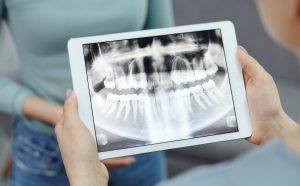 ¿Por qué se pone una corona provisional antes de la definitiva en el implante dental?
