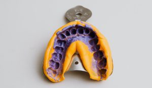 ¿Sabes qué son los Implantes Dentales Endoóseos?